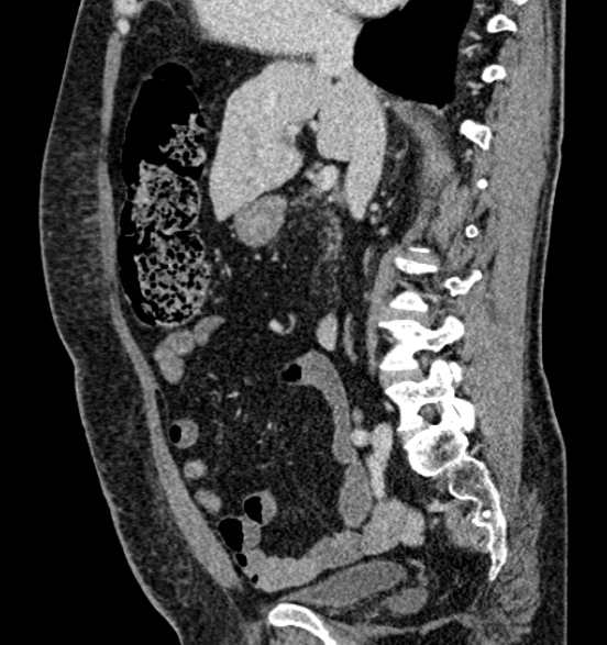 Bilateral rectus sheath hematomas (Radiopaedia 50778-56252 B 36).jpg
