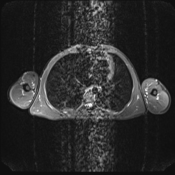 File:Bilateral spinoglenoid notch ganglion cysts (Radiopaedia 29577-30082 E 23).jpg