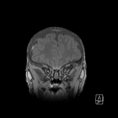 Bilateral subdural hemorrhage and parietal skull fracture (Radiopaedia 26058-26190 Coronal T1 12).png