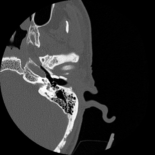 Bilateral temporal bone fractures (Radiopaedia 29482-29970 D 68).jpg