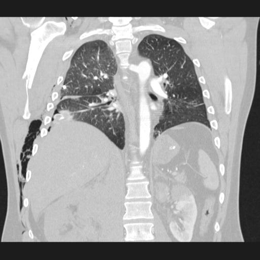Bilateral traumatic renovascular injury (Radiopaedia 32051-32995 Coronal lung window 51).jpg