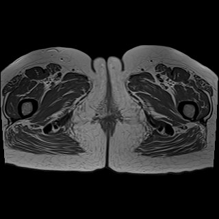 Bilateral tubo-ovarian abscesses (Radiopaedia 58635-65829 Axial T1 C+ 54).jpg