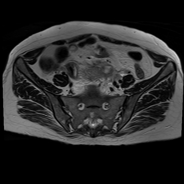 Bilateral tubo-ovarian abscesses (Radiopaedia 58635-65829 Axial T2 10).jpg