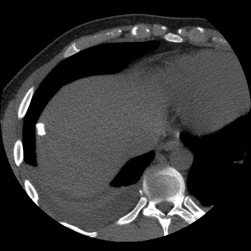 Bile leak from liver traumatic laceration (Radiopaedia 63463-72077 Axial Biliscopin 8).jpg