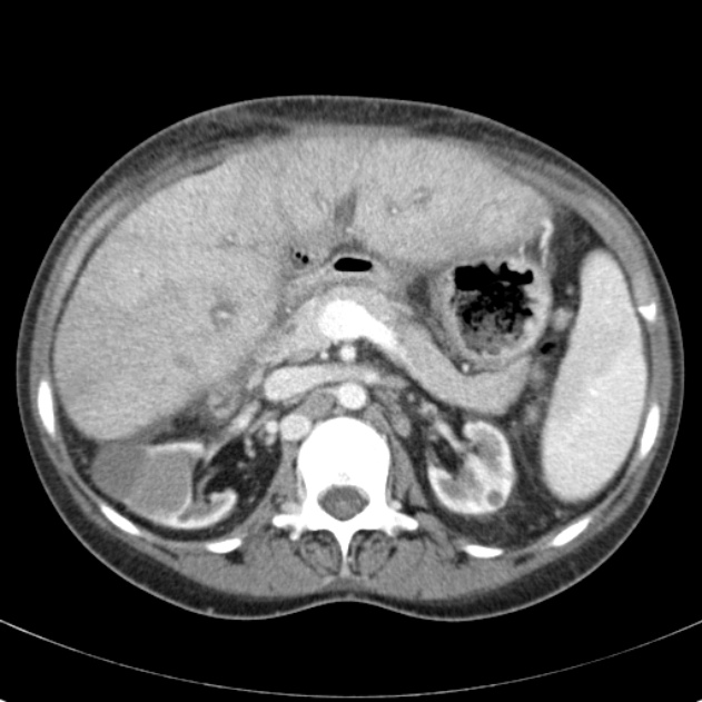 Biliary necrosis - liver transplant (Radiopaedia 21876-21846 B 27).jpg