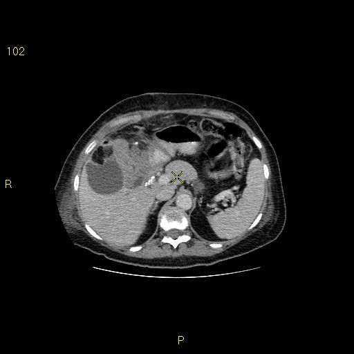 File:Biloma with drainage into the colon (Radiopaedia 20032-20068 A 7).jpg