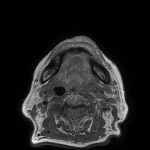 Bisphosphonate-related osteonecrosis of the maxilla (Radiopaedia 51367-57101 Axial T1 8).jpg