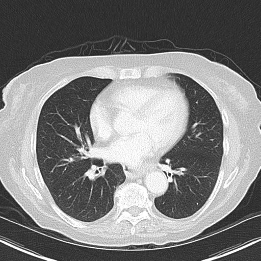 File:Bladder and bowel cancers (Radiopaedia 37688-39592 Axial lung window 32).png