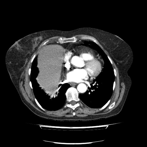 Bladder tumor detected on trauma CT (Radiopaedia 51809-57609 A 58).jpg