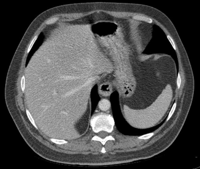 File:Bleeding duodenal ulcer and adenomyomatosis of gallbladder (Radiopaedia 61834-69861 A 18).jpg