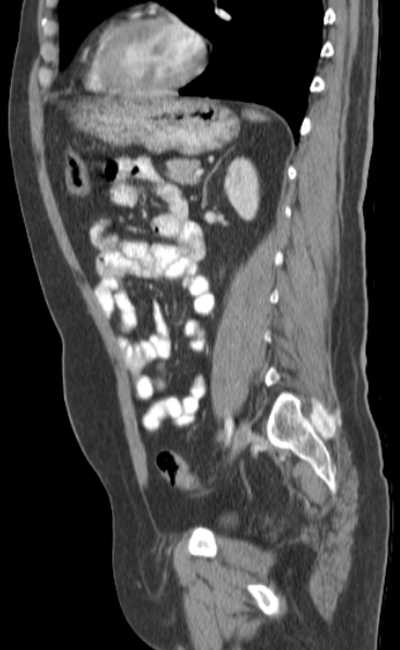 Bleeding duodenal ulcer and adenomyomatosis of gallbladder (Radiopaedia 61834-69861 C 65).jpg