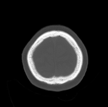 Blood on the tentorium simulating hyperdense transverse sinus (Radiopaedia 55521-61991 Axial bone window 47).jpg