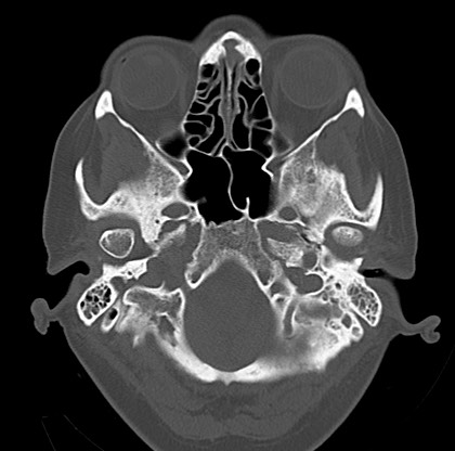 File:Blood on the tentorium simulating hyperdense transverse sinus (Radiopaedia 55521-61991 Axial bone window 6).jpg