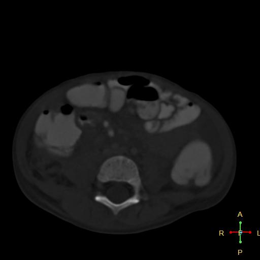 File:Blunt abdominal trauma (Radiopaedia 24780-25044 Axial bone window 1).jpg