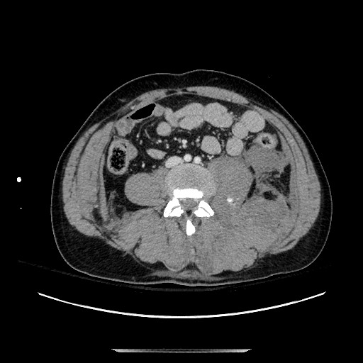 Blunt abdominal trauma with solid organ and musculoskelatal injury with active extravasation (Radiopaedia 68364-77895 A 92).jpg