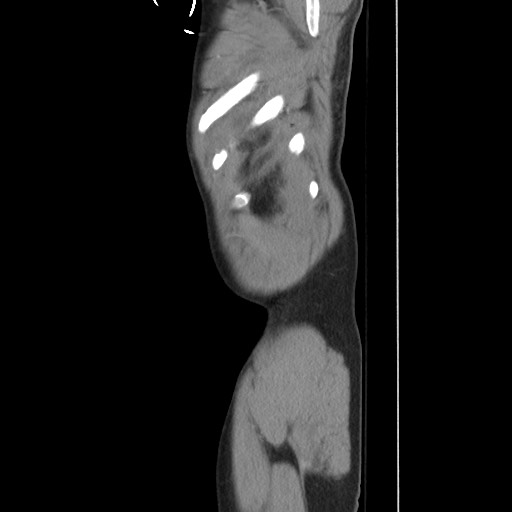 File:Blunt abdominal trauma with solid organ and musculoskelatal injury with active extravasation (Radiopaedia 68364-77895 C 134).jpg