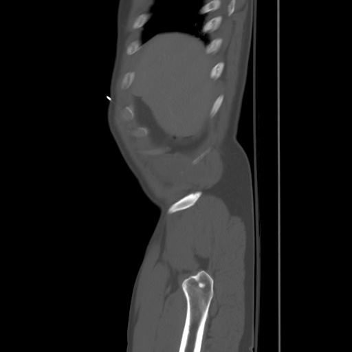Blunt abdominal trauma with solid organ and musculoskelatal injury with active extravasation (Radiopaedia 68364-77895 Sagittal bone window 2).jpg