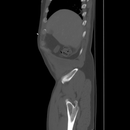 File:Blunt abdominal trauma with solid organ and musculoskelatal injury with active extravasation (Radiopaedia 68364-77895 Sagittal bone window 7).jpg