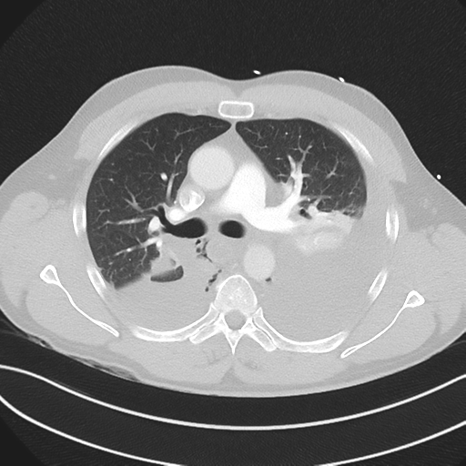 Boerhaave syndrome (Radiopaedia 39382-41660 Axial lung window 22).png