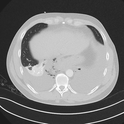 Boerhaave syndrome (Radiopaedia 39382-41660 Axial lung window 44).png