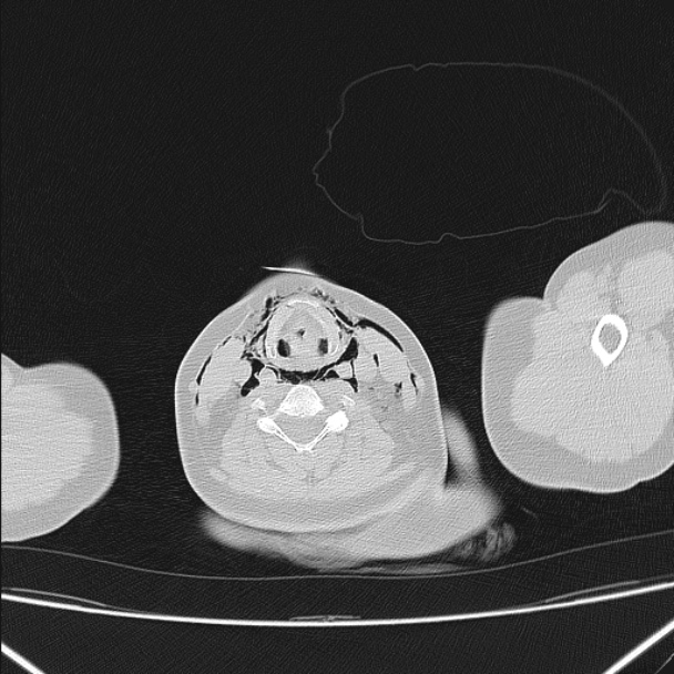 Boerhaave syndrome (Radiopaedia 45644-49799 Axial lung window 8).jpg