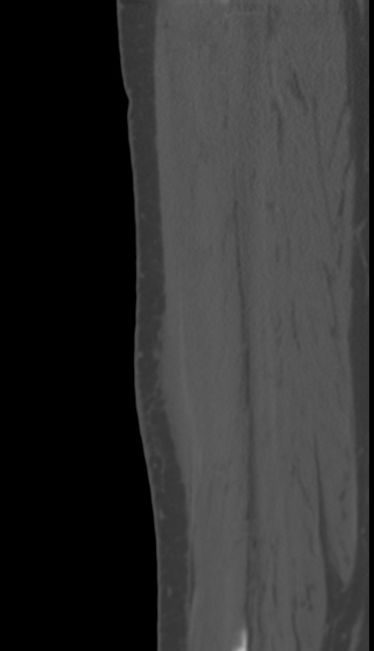 Bone metastasis - tibia (Radiopaedia 57665-64609 Sagittal bone window 128).jpg