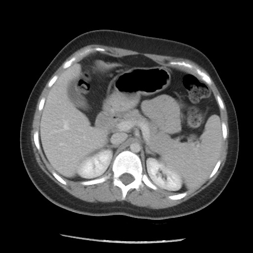 File:Borderline mucinous tumor (ovary) (Radiopaedia 78228-90808 A 76).jpg