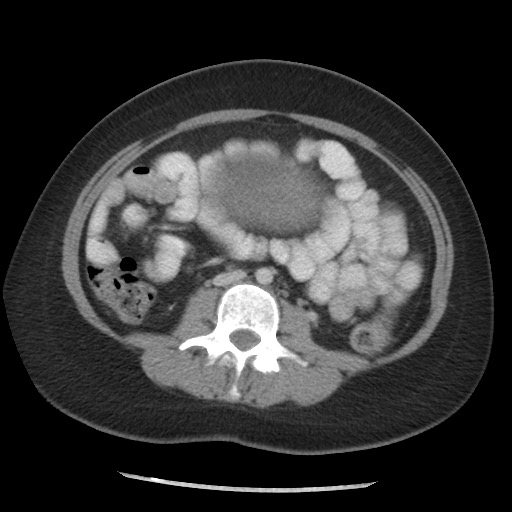File:Borderline mucinous tumor (ovary) (Radiopaedia 78228-90808 A 93).jpg