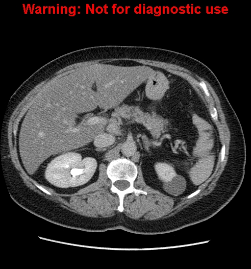 File:Bosniak renal cyst - type II (Radiopaedia 23404-23468 F 18).jpg