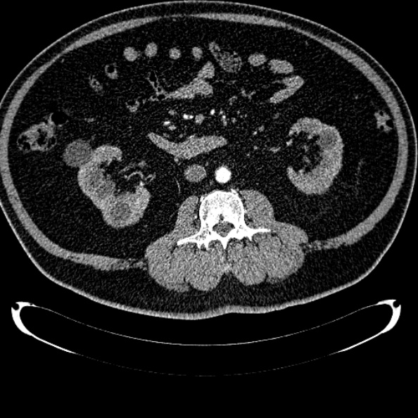 Bosniak renal cyst - type IV (Radiopaedia 24244-24518 B 180).jpg