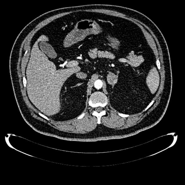 Bosniak renal cyst - type IV (Radiopaedia 24244-24518 B 91).jpg