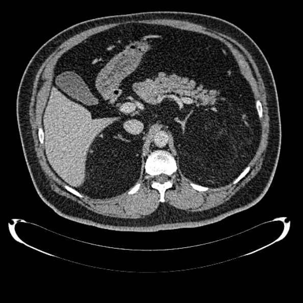 Bosniak renal cyst - type IV (Radiopaedia 24244-24518 C 98).jpg