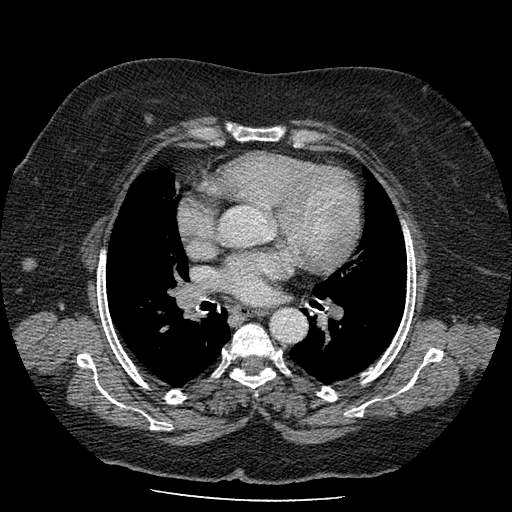 Bovine aortic arch - right internal mammary vein drains into the superior vena cava (Radiopaedia 63296-71875 A 78).jpg