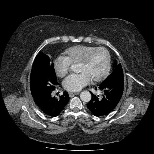 Bovine aortic arch - right internal mammary vein drains into the superior vena cava (Radiopaedia 63296-71875 A 89).jpg
