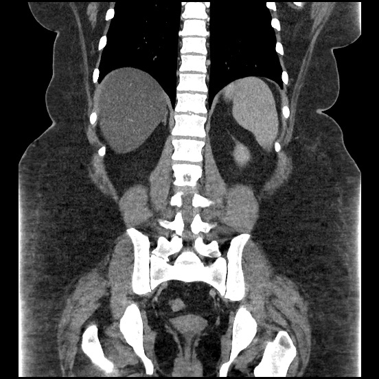 File:Bowel and splenic infarcts in acute lymphocytic leukemia (Radiopaedia 61055-68913 B 43).jpg