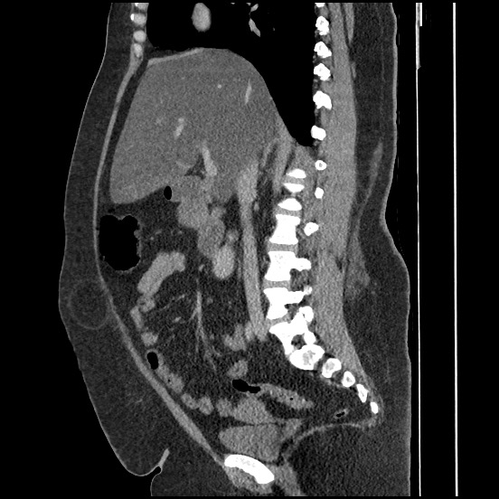 Bowel and splenic infarcts in acute lymphocytic leukemia (Radiopaedia 61055-68913 C 46).jpg