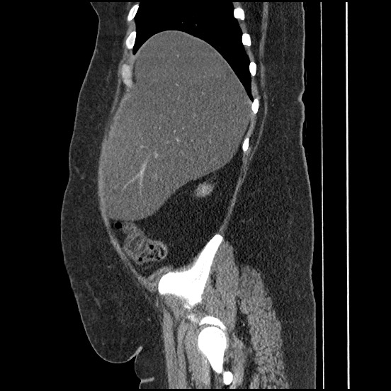 Bowel and splenic infarcts in acute lymphocytic leukemia (Radiopaedia 61055-68913 C 60).jpg