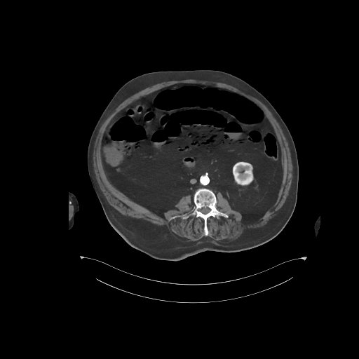 File:Bowel ischemia secondary to SMA occlusion with extensive portomesenteric venous gas (Radiopaedia 54656-60871 A 34).jpg