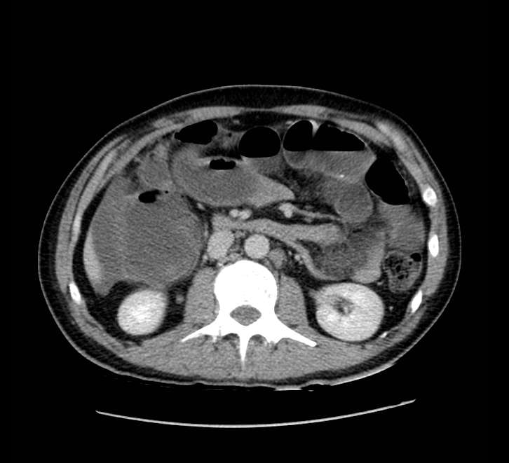 Bowel obstruction from colon carcinoma (Radiopaedia 22995-23028 A 36).jpg