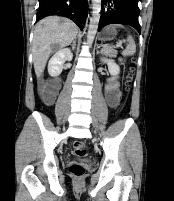 Bowel obstruction from colon carcinoma (Radiopaedia 22995-23028 C 48).jpg