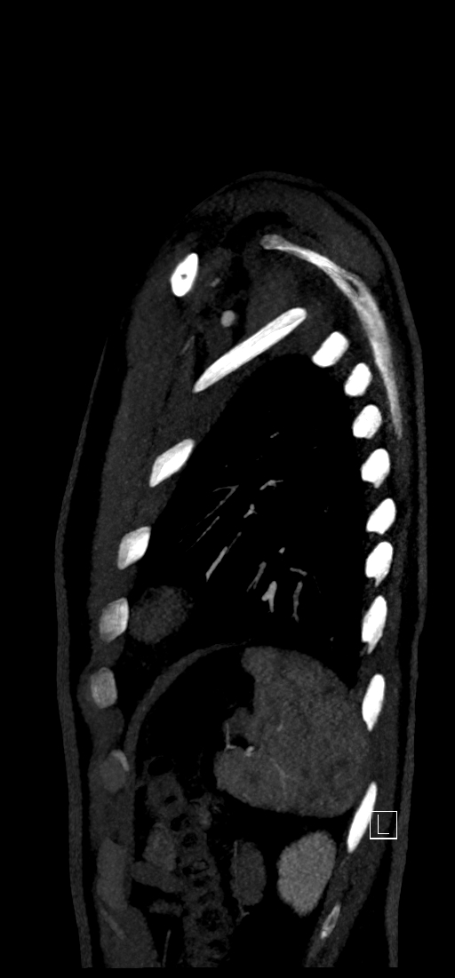 Brachiocephalic trunk pseudoaneurysm (Radiopaedia 70978-81191 C 79).jpg