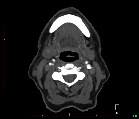 Brachiocephalic trunk stenosis (Radiopaedia 87242-103519 A 90).jpg