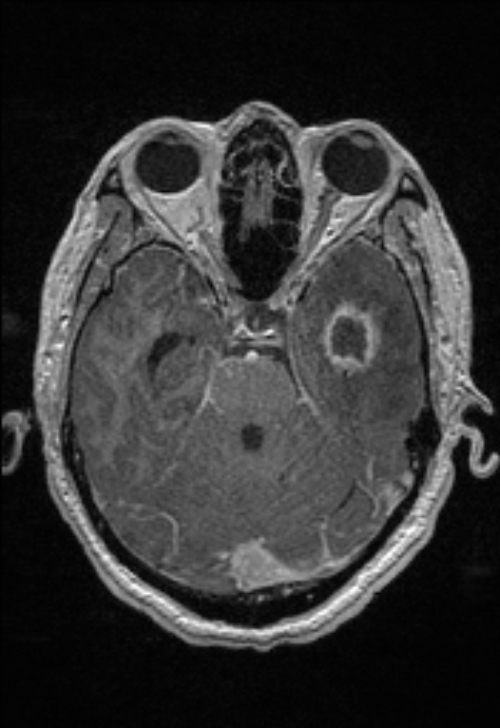 Brain abscess with ventriculitis (Radiopaedia 85703-101495 Axial T1 C+ 64).jpg