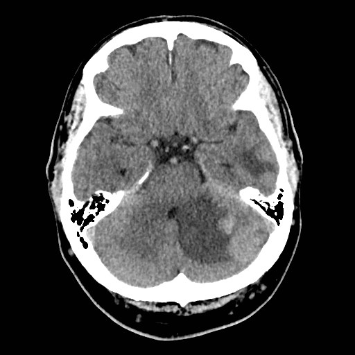 File:Brain metastases from lung cancer (Radiopaedia 83839-99027 Axial non-contrast 10).jpg