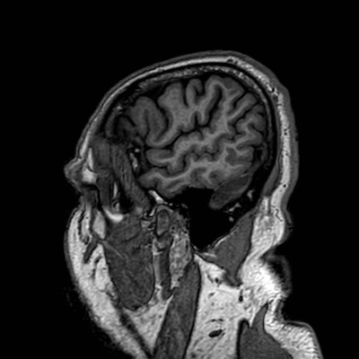Brain metastases from lung cancer (Radiopaedia 83839-99028 Sagittal T1 14).jpg