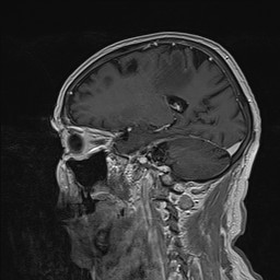 Brain metastasis (Radiopaedia 42617-45761 Sagittal T1 C+ 36).jpg