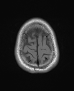 File:Brain metastasis (large cystic mass) (Radiopaedia 47497-52107 Axial T1 25).png