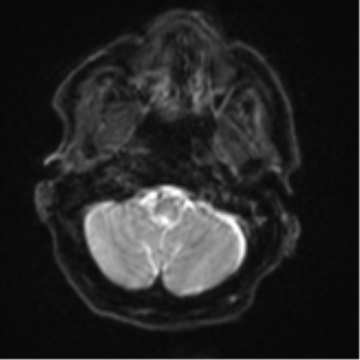 Brain metastasis (lung cancer) (Radiopaedia 48289-53179 Axial DWI 3).png