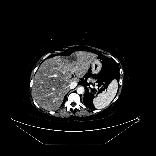File:Breast cancer pseudocirrhosis with lobar invovlement (Radiopaedia 81080-94670 Axial liver window 45).jpg