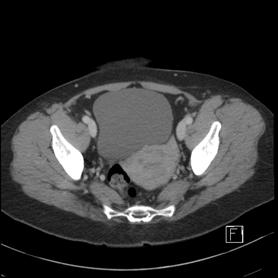Breast metastases from renal cell cancer (Radiopaedia 79220-92225 C 100).jpg